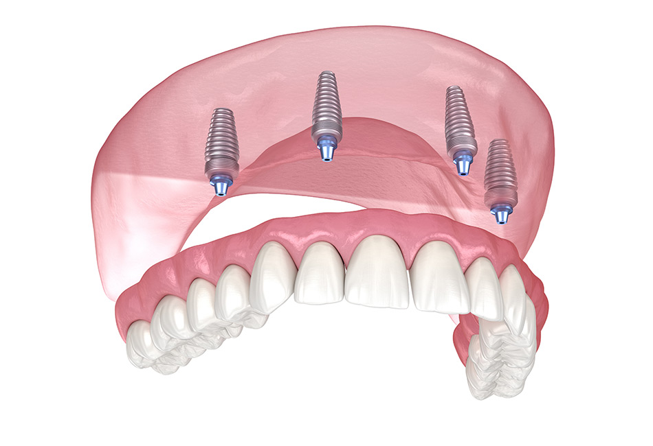 Full Arch Denture