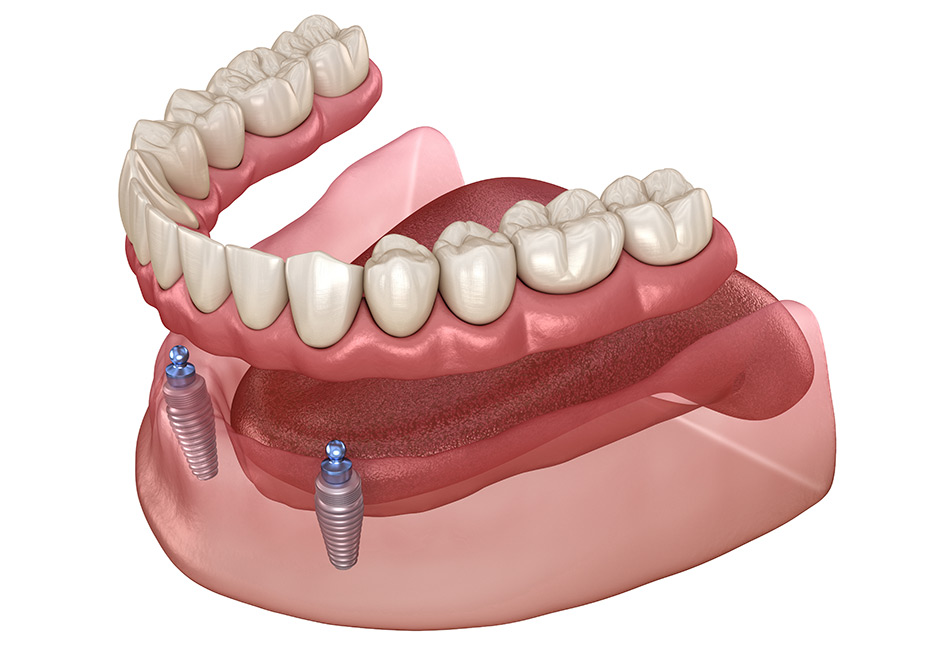 Dental Implants Overdenture
